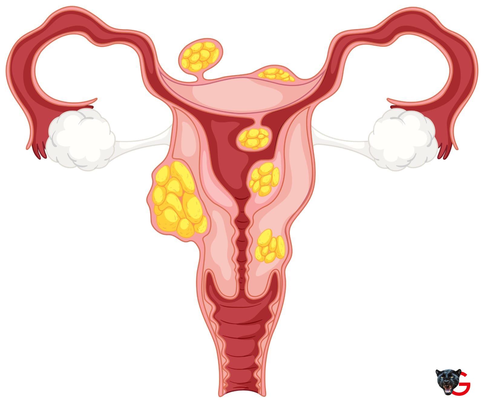 Il tango della PCOS Ovaio policistico, al via dal Senato la maratona informativa sulla sindrome Martedì 18 febbraio 2025 - SprayNews - Monica Macchioni